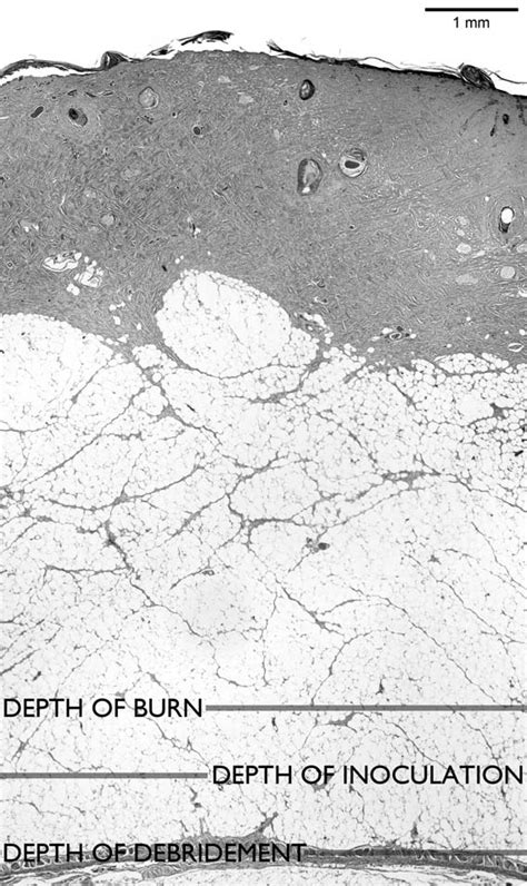 measuring burn depth thickness researchgate|Improving the histologic characterization of burn depth.